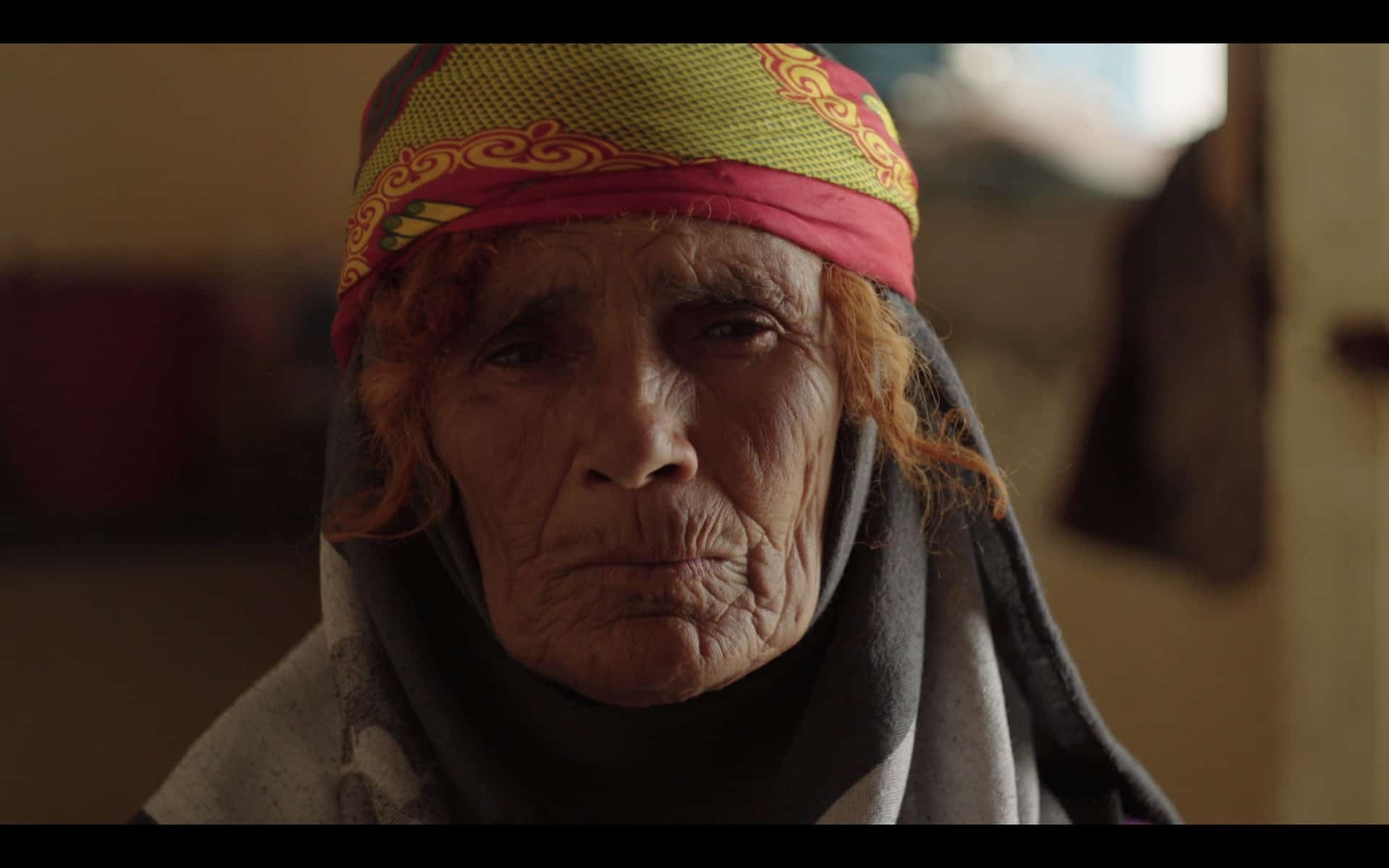 On la nomme brûlure